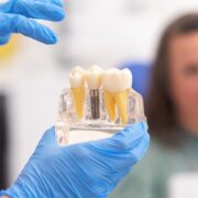 Myths and Facts About Dental Implants