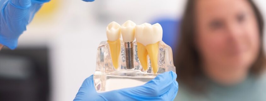 Myths and Facts About Dental Implants