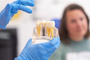 Myths and Facts About Dental Implants